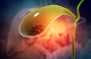 Gallbladder stone treatment in Coimbatore