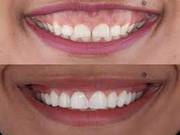 gummy smile treatment