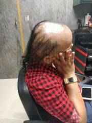-  Hair Extensions in Delhi- Best Extensions Clinic