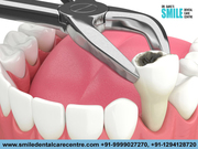 Painless Root Canal Treatment Overview 