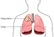 Lung Cancer Treatment in Gurgaon