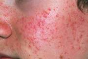  Laser Hair Removal Clinic Near Me - Vitiligo Treatment Near Me - Boto