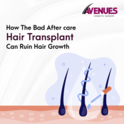 Best Hair Doctor in Ahmedabad,  Avenues Cosmetic