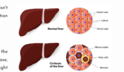  Liver Disease Doctor in Ahmedabad,  Liver Disease Doctor in Gujarat