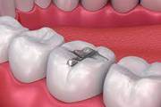 White Dental Fillings Cost in Gurgaon @9289288848