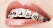 Teeth Braces in Gurgaon @9289288848