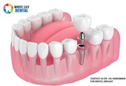 Dental Implants in Noida @9289288848 | Dental Implant Cost