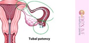 Diagnostic laparoscopy for tubal patency - Dr. Rohit Luthra