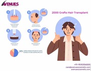 2000 Grafts Hair Transplant Cost in India