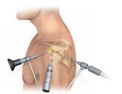 Robotic Joint Replacement Surgery
