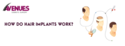 Best Hair Implant In Ahmedabad
