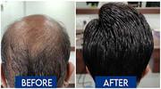 Transform Your Look with Expert Hair Transplant Services in Nashik