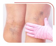 DVT Treatment: Deep Vein Thrombosis Treatment in India