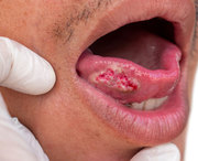 Best Mouth Cancer Doctor in Ahmedabad
