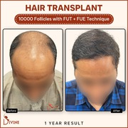 Long Hair Transplant in Delhi by Dr. Amit Gupta