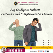 Best Hair Patch & Hair Replacement Treatment in Chennai | Non-Surgical