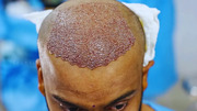 best hair transplant in ahmedabad